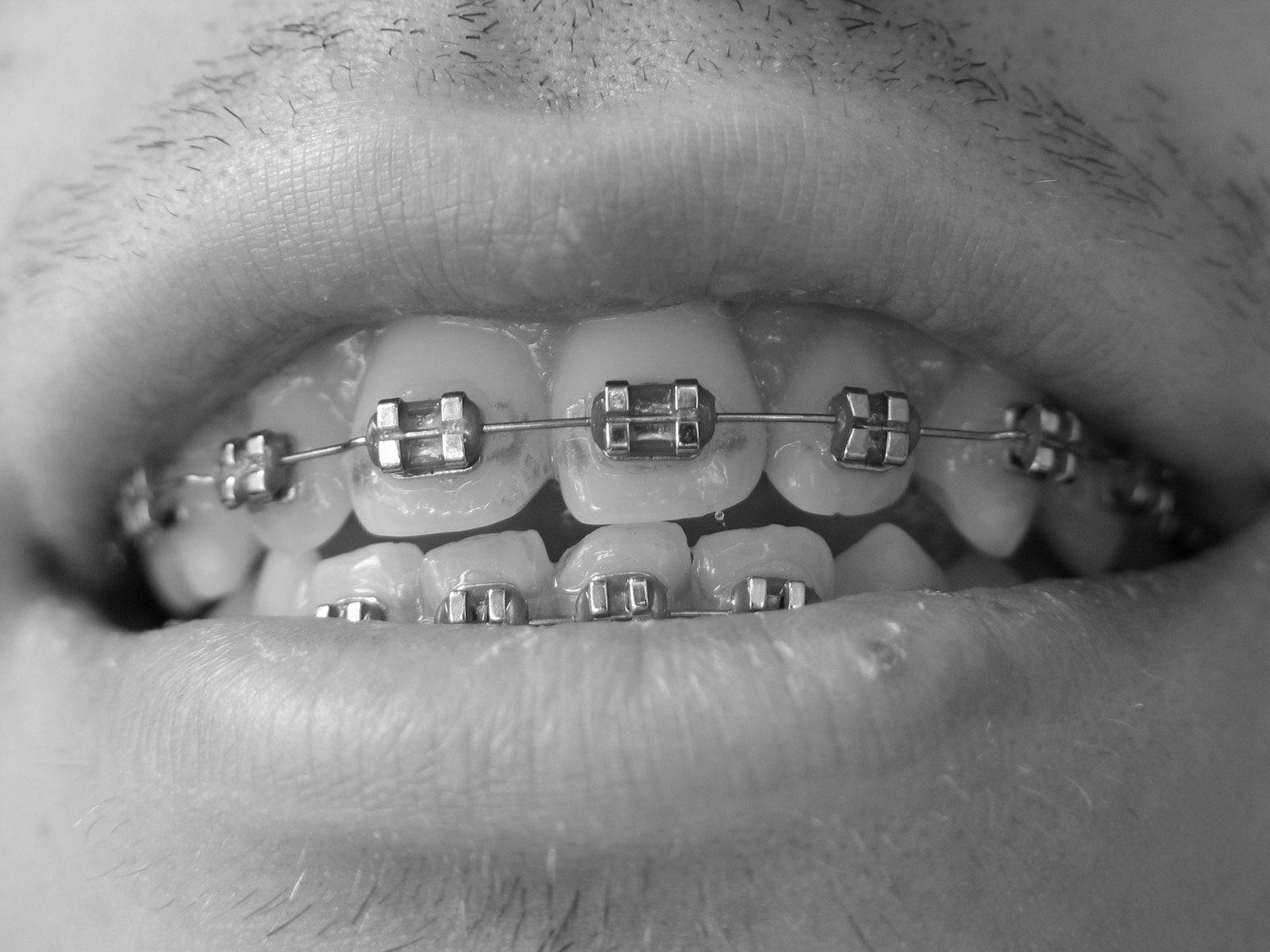 Braces vs. Invisalign Braces vs. Invisalign