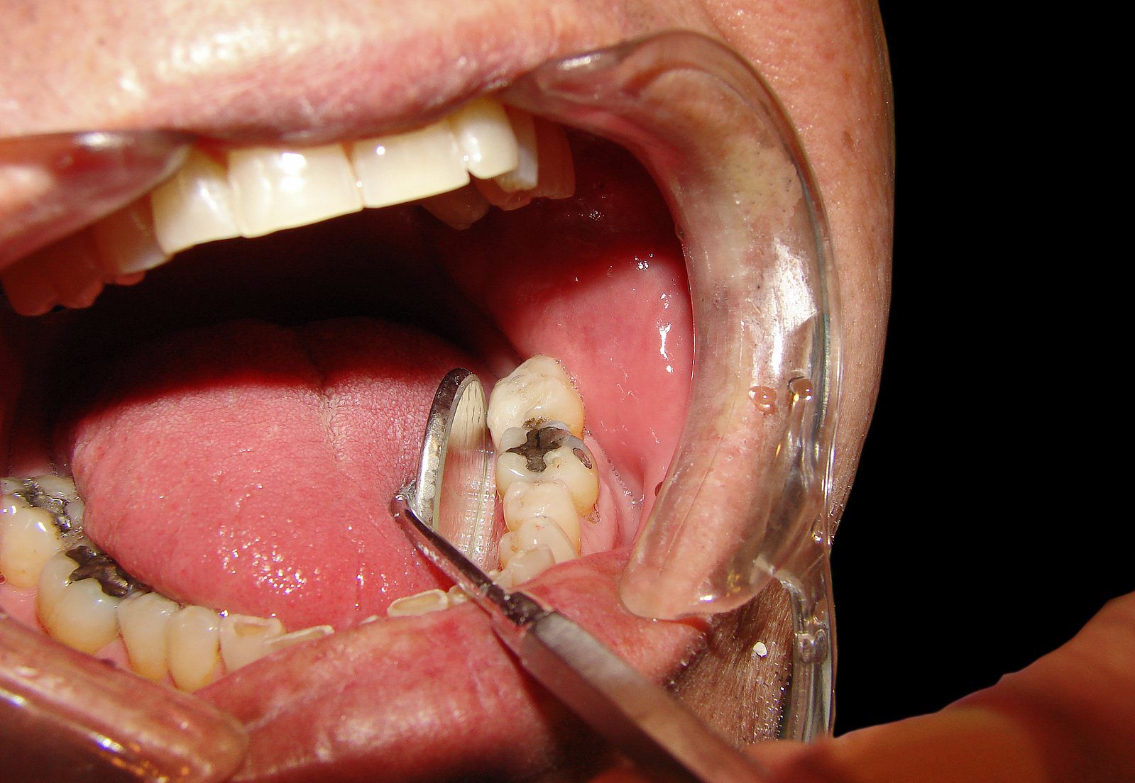 What to Do if You Break a Tooth What to Do if You Break a Tooth