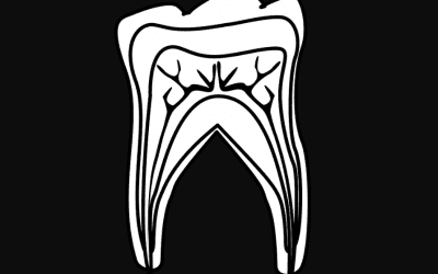 What You Should Know About Wisdom Tooth Extraction