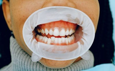 Seven Signs of Unhealthy Gums