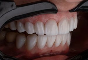 How Straight Teeth Can Improve Your Quality of Life