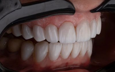 How Straight Teeth Can Improve Your Quality of Life